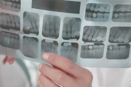 radiografía para puentes dentales | Clínica dental en Valencia ARTDENTA