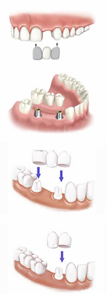 Tipos de Puentes dentales | Clínica dental en Valencia ARTDENTA