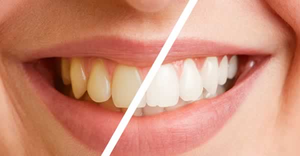 Cambio de color pulido dental Artdenta