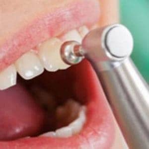Técnica de Pulido Dental Artdenta