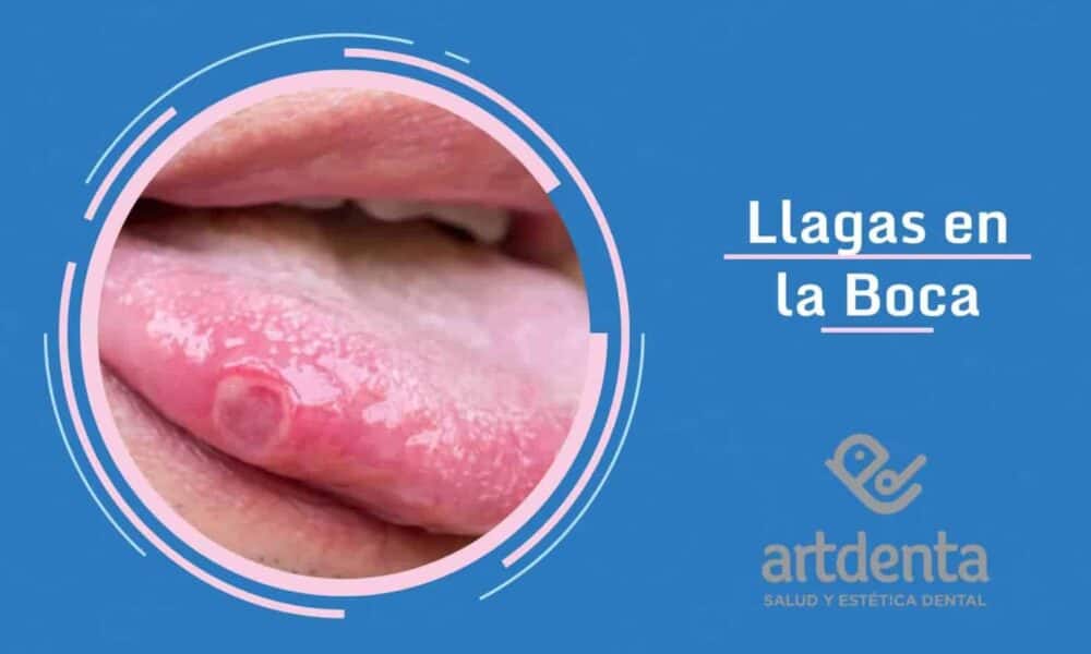 Banner llagas buscales | Clínica Dental Artdenta