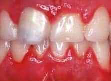 Gingivoestomatitis Herpetica | Clínica Dental Artdenta