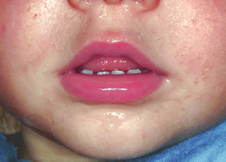Sialorrea en bebés | Clínica Dental Artdenta