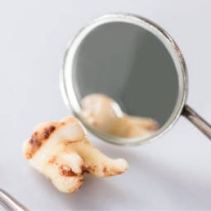 Revisando caries para Empastes Dentales | Clínica Dental Artdenta Valencia