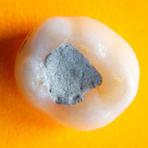 Empastes Dentales | Clínica Dental Artdenta Valencia