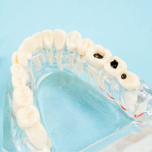 Modelo de Empastes Dentales | Clínica Dental Artdenta Valencia