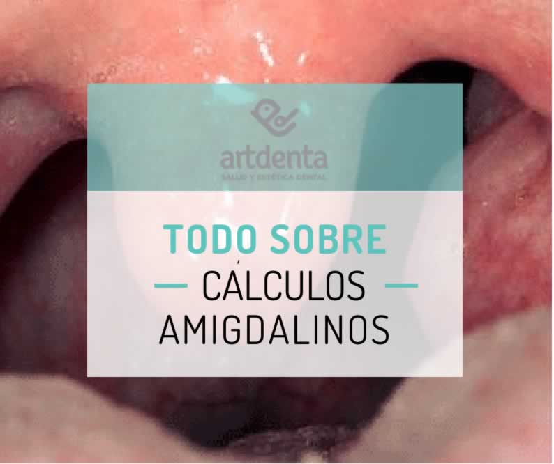 Cálculos Amigdalinos | Clínica Dental Artdenta
