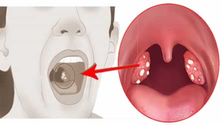 Cálculos Amigdalinos Clínica Dental Artdenta