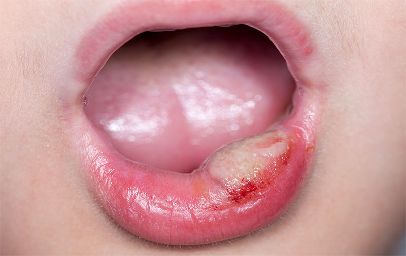Llagas en boca - Dolor Campanilla y Paladar Inflamado | Clínica Dental Artdenta Valencia