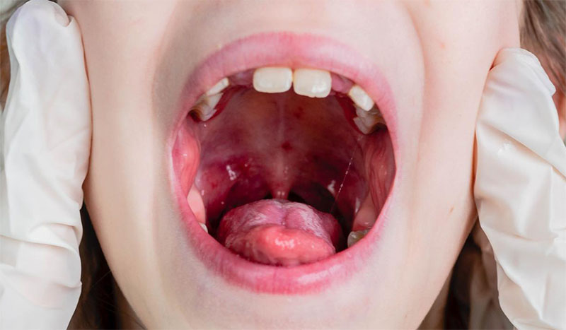 Paladar Inflamado Niño - Dolor Campanilla y Paladar Inflamado | Clínica Dental Artdenta Valencia