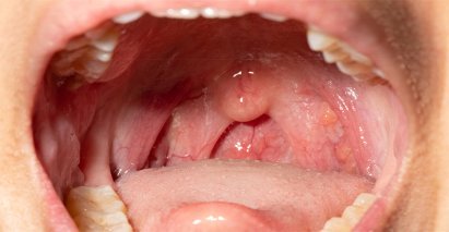 Uvula Inflamada - Dolor Campanilla y Paladar Inflamado | Clínica Dental Artdenta Valencia