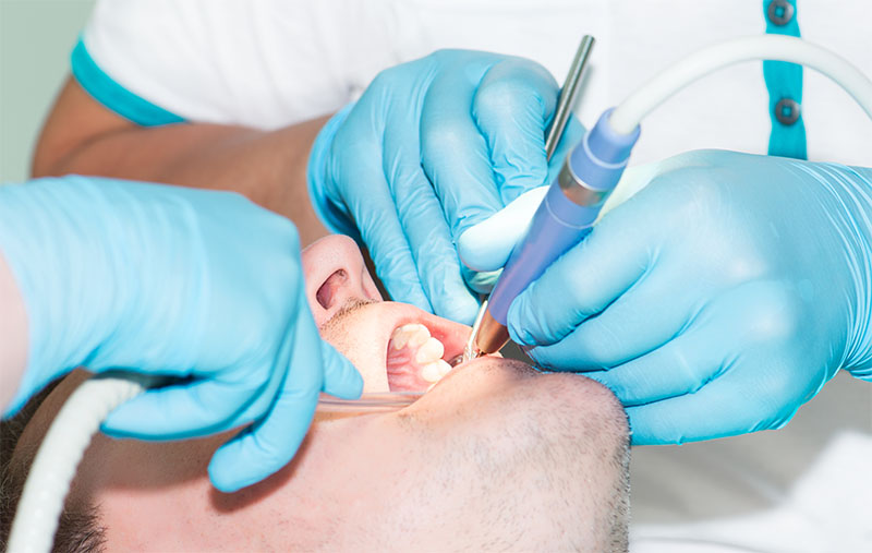 Limpieza Dental - Dolor Campanilla y Paladar Inflamado | Clínica Dental Artdenta Valencia