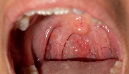 Paladar Inflamado - Dolor Campanilla y Paladar Inflamado | Clínica Dental Artdenta Valencia