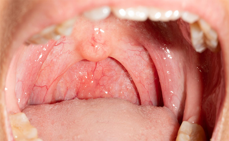Uvula Inflamada - Dolor Campanilla y Paladar Inflamado | Clínica Dental Artdenta Valencia