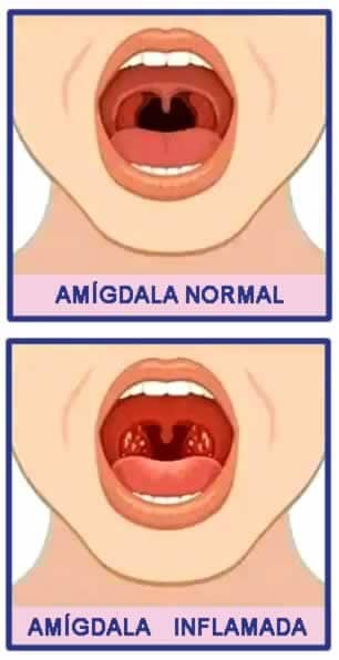 Amigdala inflamada | Clínica Dental Artdenta