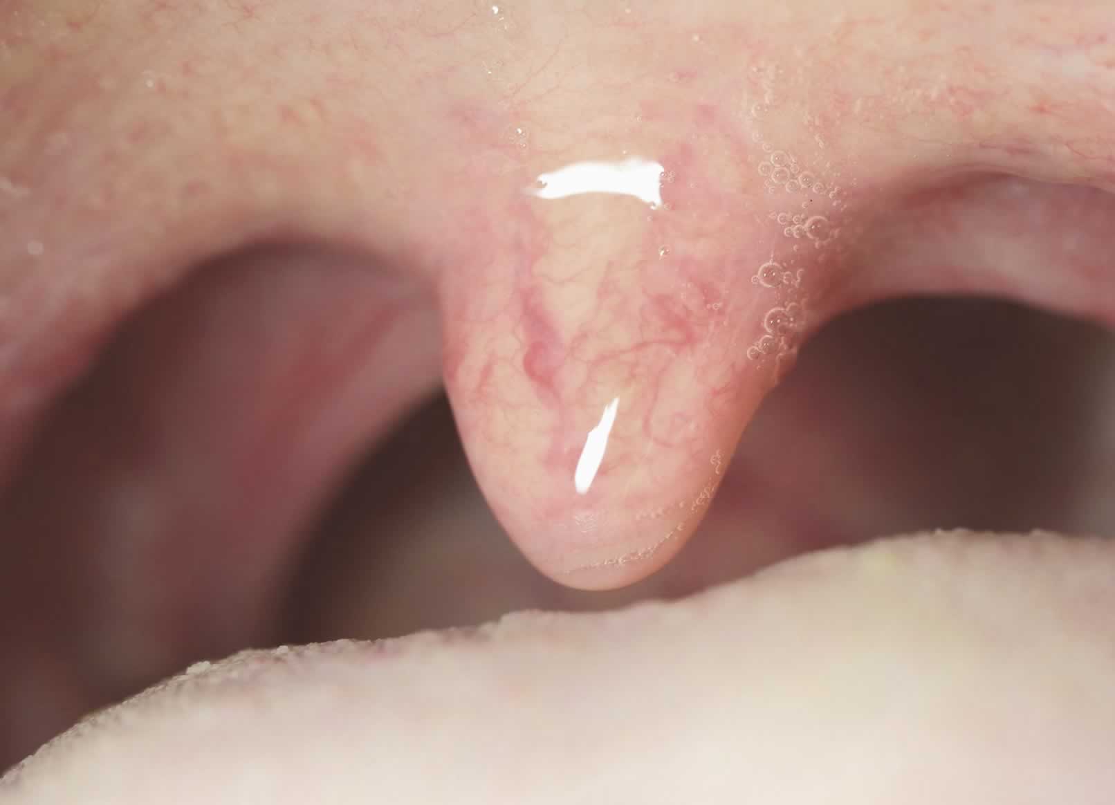 Campanilla inflamada | Clínica Dental Artdenta