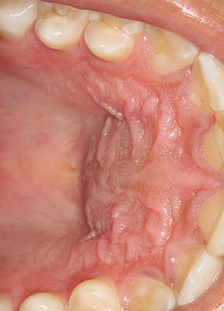 Paladar Inflamado | Clínica Dental Artdenta