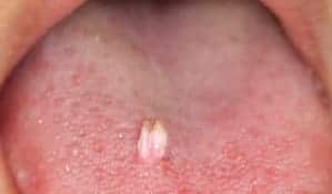 Papiloma Escamoso | Clínica Dental Artdenta