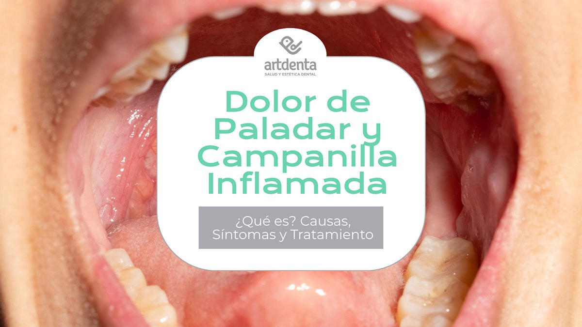 Banner Dolor Campanilla y Paladar Inflamado | Clínica Dental Artdenta Valencia