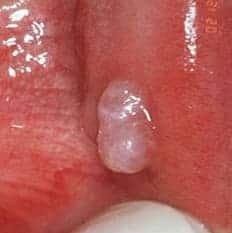 Mucoceles | Clínica Dental Artdenta