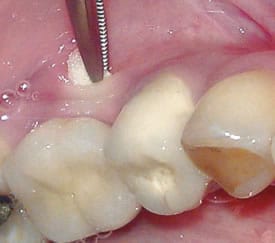 Abscesos gingivales | Periodoncia | Clínica Dental Artdenta en Valencia