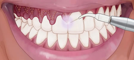 Gingivectomía | Periodoncia | Clínica Dental Artdenta en Valencia
