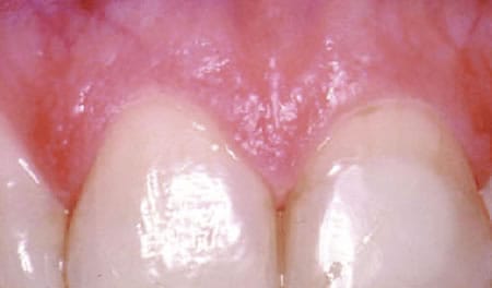 Encías libres marginal | Periodoncia | Clínica Dental Artdenta en Valencia