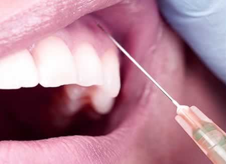 Anestesia Dental | Clínica Dental Artdenta Valencia