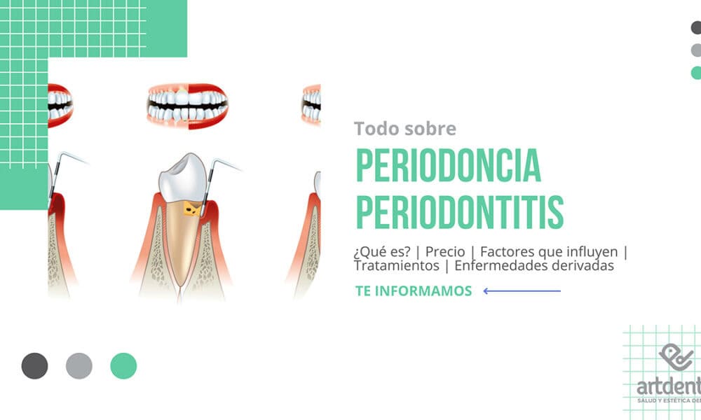 Banner Periodoncia Periodontitis Precio| Clínica Dental Artdenta Valencia