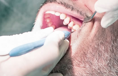 Limpieza bucal sarro | Clínica Dental Artdenta Valencia