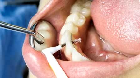 Desibridación | Clínica Dental Artdenta Valencia