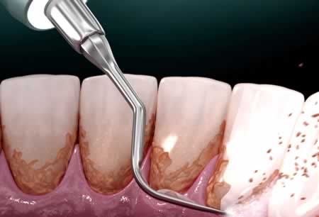 Eliminar Biopelícula | Clínica Dental Artdenta Valencia