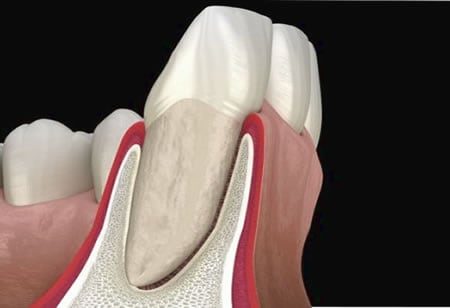 Hueso Alveolar | Periodoncia | Clínica Dental Artdenta en Valencia