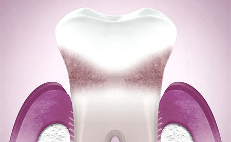 Periodontitis | Periodoncia | Clínica Dental Artdenta en Valencia