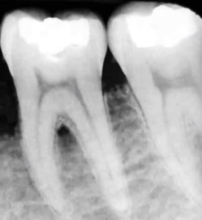 Sarro Negro, ¿Qué Es? ¿Cómo Se Forma? | Clínica Dental En VALENCIA ...