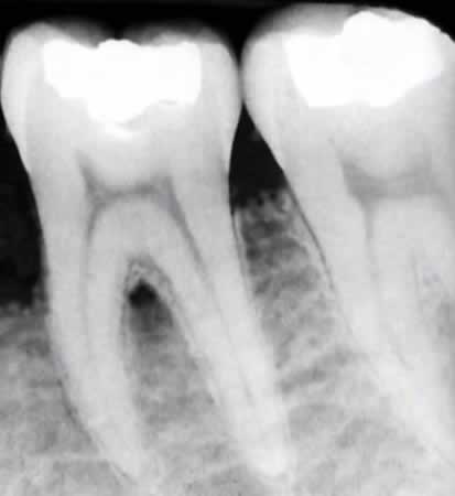 Rayos X en Periodoncia | Clínica Dental Artdenta Valencia