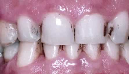 Sarro Negro | Clínica Dental Artdenta Valencia