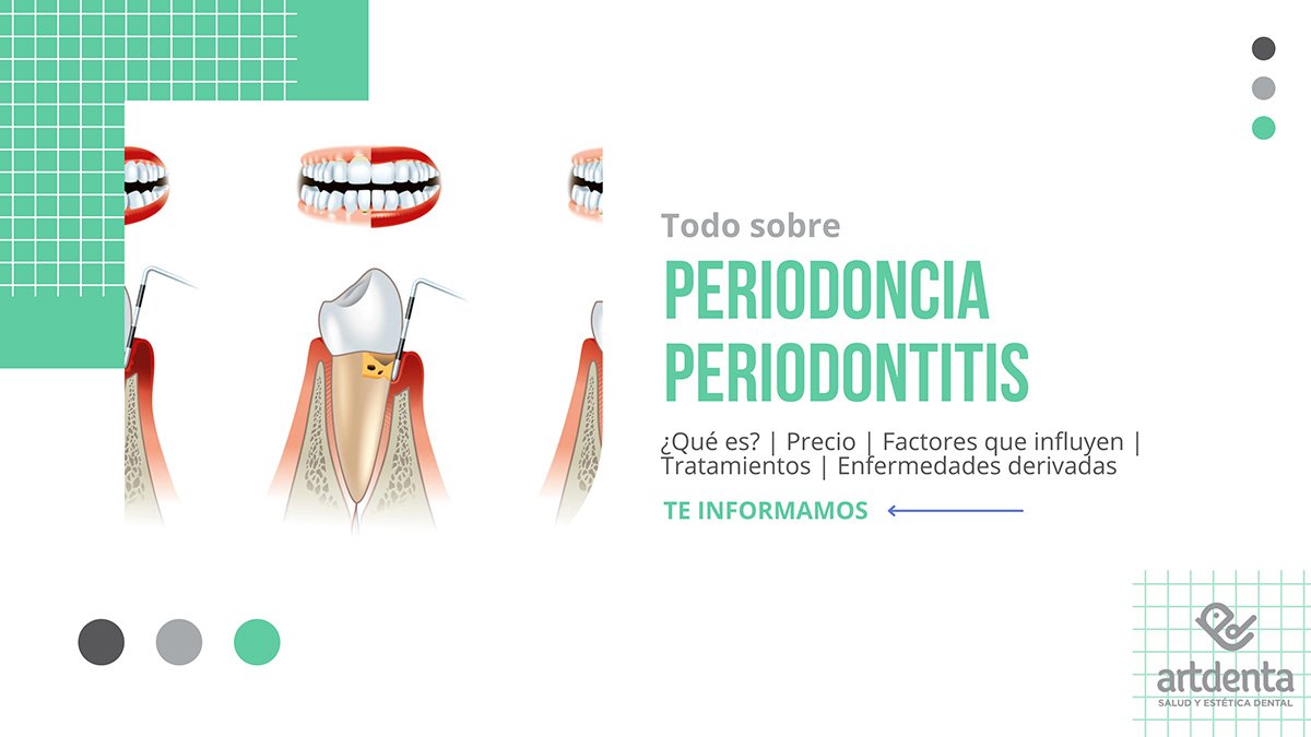 Banner Periodoncia Periodontitis Precio| Clínica Dental Artdenta Valencia