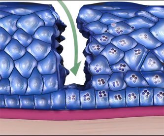 Cancer por Papiloma Humano Bucal | Clínica Dental Artdenta Valencia
