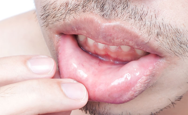 Labio Papiloma Humano Bucal | Clínica Dental Artdenta Valencia