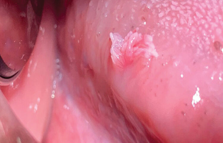 Papiloma Humano Bucal | Clínica Dental Artdenta Valencia