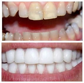 Comparativa tratamiento lesión Dental por tetraciclina | Clínica Dental Artdenta en Valencia