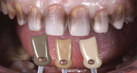 Grados de lesión Dental por tetraciclina | Clínica Dental Artdenta en Valencia