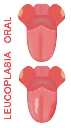 Leocoplasia Oral | Papiloma en Boca | Clínica Dental Artdenta Valencia