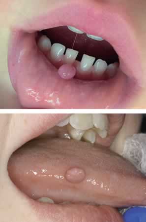 Tumor Oral en niños | Papiloma en Boca | Clínica Dental Artdenta Valencia