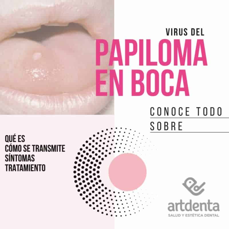 Virus del Papiloma en Boca | Clínica Dental Artdenta Valencia
