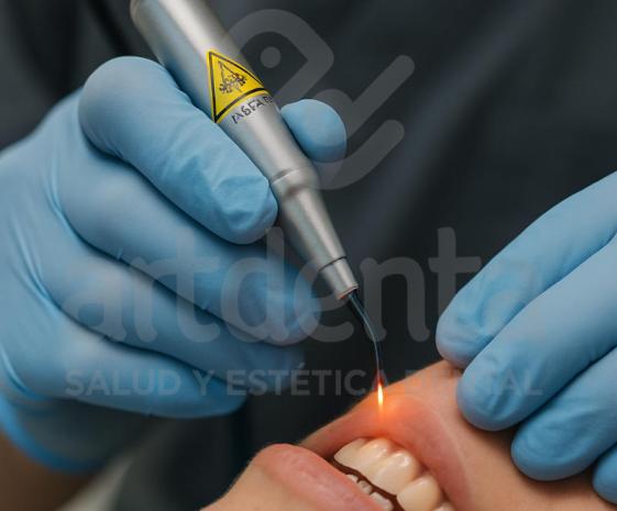 Tratamiento Laser Gingivetomía | Clínica Dental Artdenta Valencia