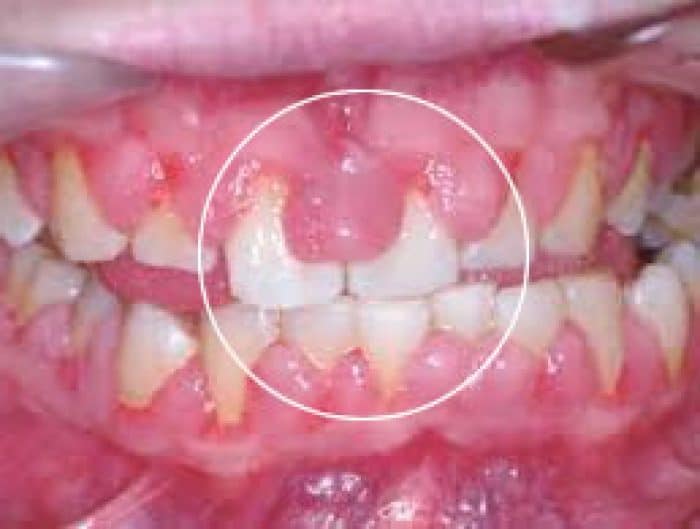 Gingivectomia, ¿Qué es? Técnicas, diagnóstico Clínica Dental en