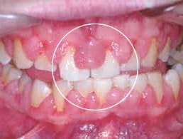 Gingiivectomía |Clínica Dental Artdenta Valenciato gingival_clinica_artdenta_valencia