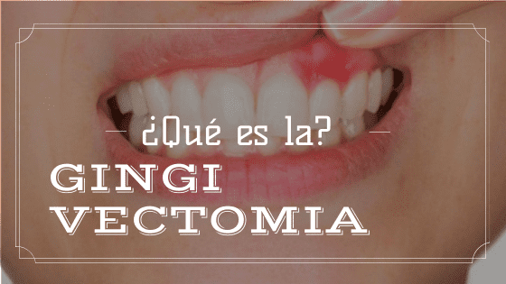 Banner que es gingivectomia | Clinica Dental Valencia